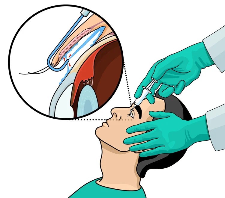 Scleral Lenses